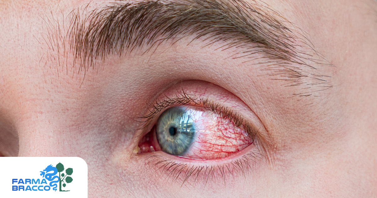 Occhi rossi e bruciore?  Ecco i rimedi e i consigli per tutelarli