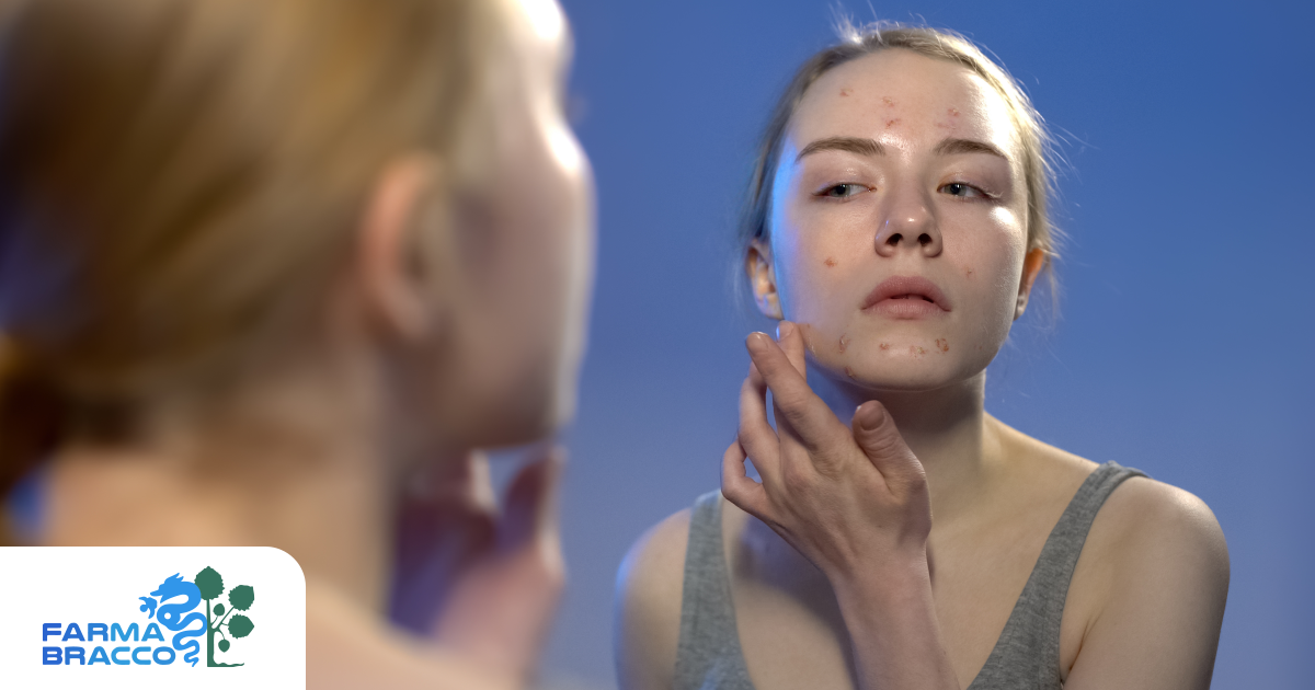 Acne ormonale: come riconoscerla e quali prodotti usare