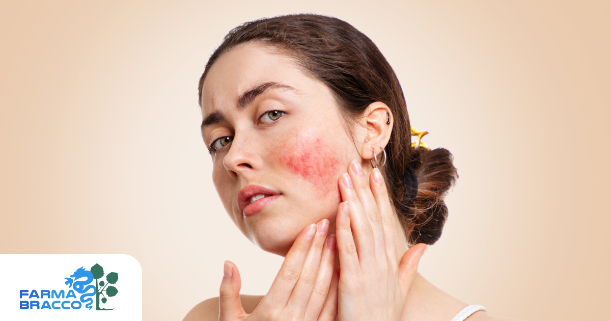 Esiste una crema miracolosa per la couperose?