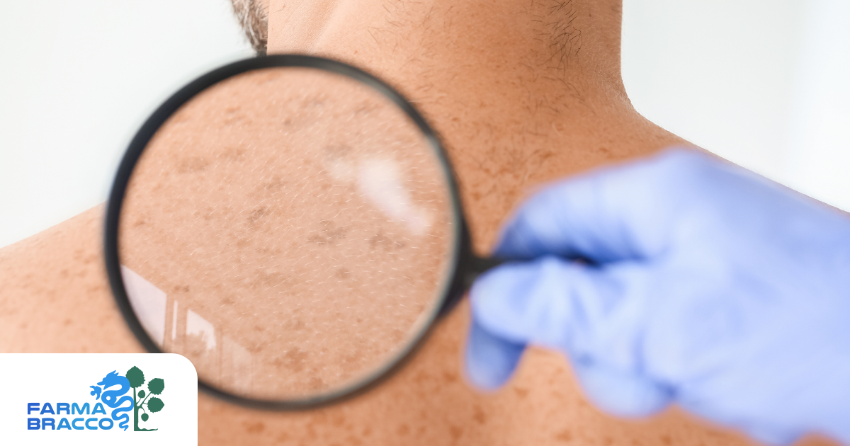 Macchie solari: prevenzione e trattamenti efficaci